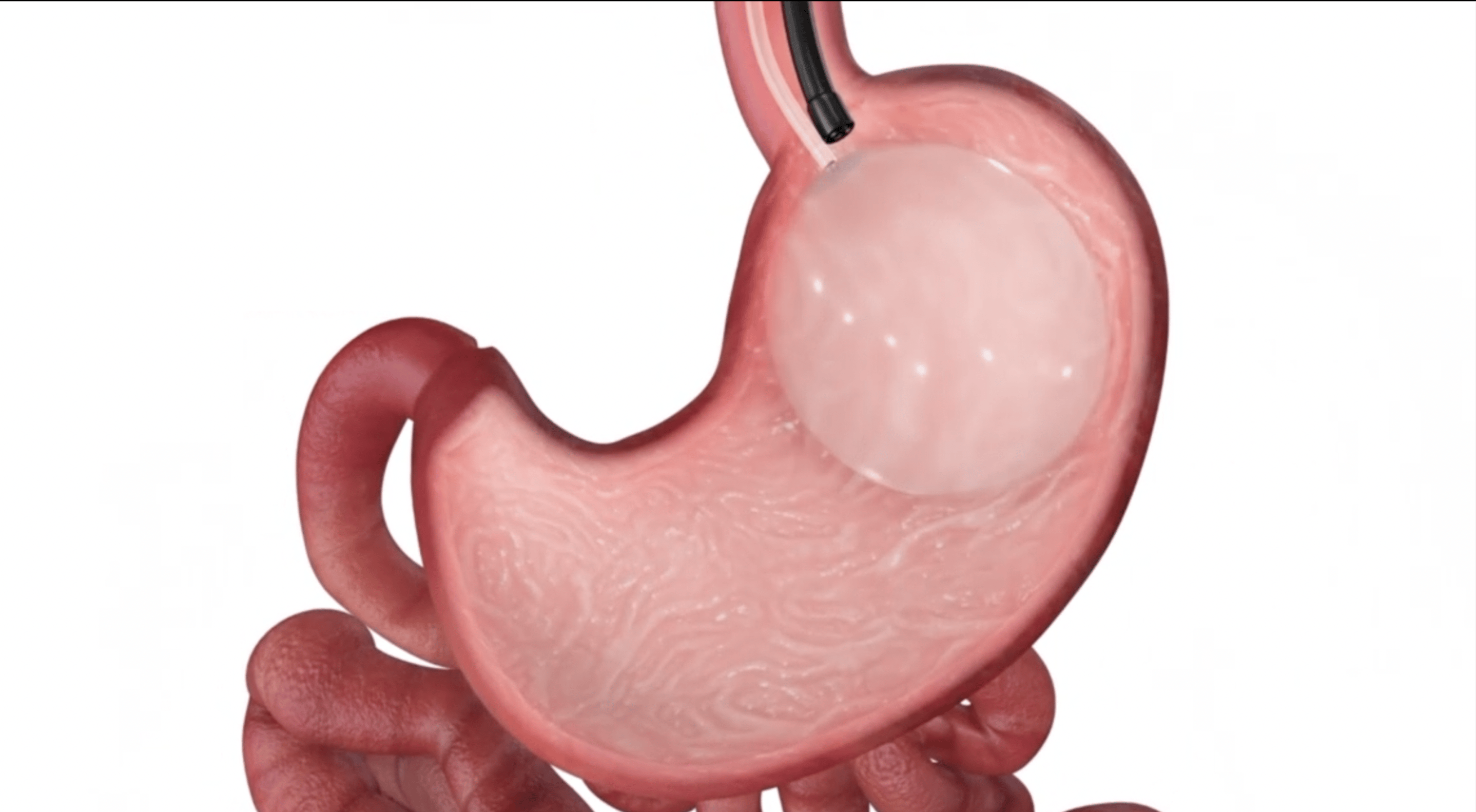 胃里放“水球”2个月瘦50斤？新型减重方式“保真”吗｜健康深一度